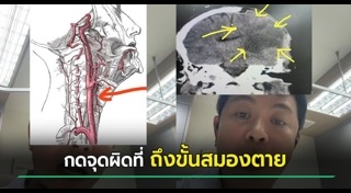 นวดกดจุด