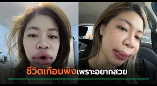 ฉีดฟิลเลอร์