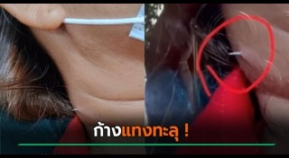 ก้างปลาติดคอ