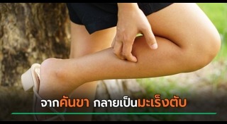 มะเร็งตับ