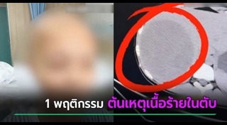 มะเร็งตับ