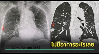 มะเร็งปอด