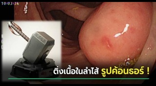 ติ่งเนื้อ