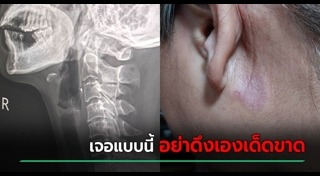 ก้างปลาติดคอ