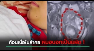 แฝดปรสิต