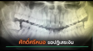 ฟันคุด