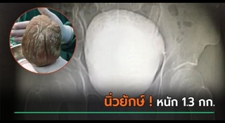 ผ่าตัดนิ่ว