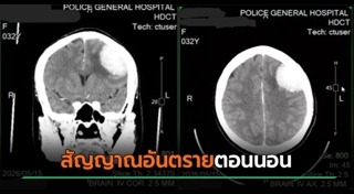 เนื้องอกในสมอง